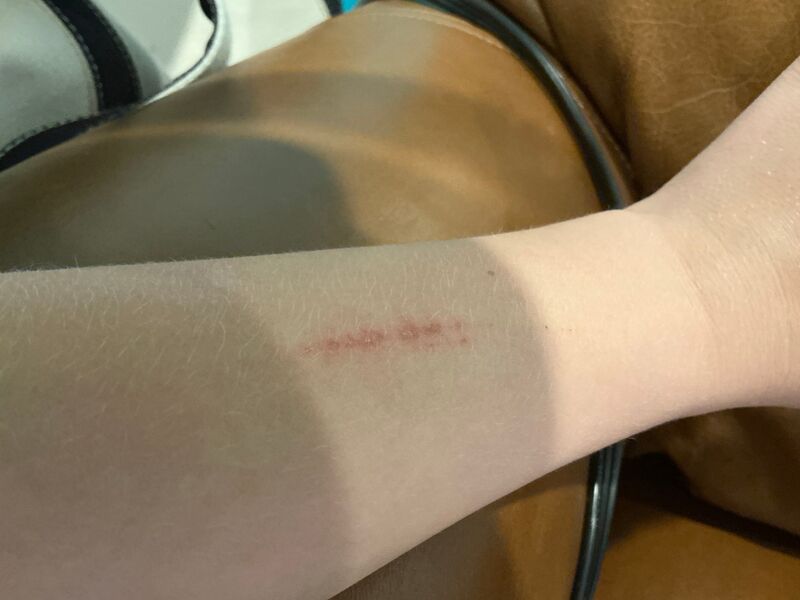 File:Ed hurt arm.jpg
